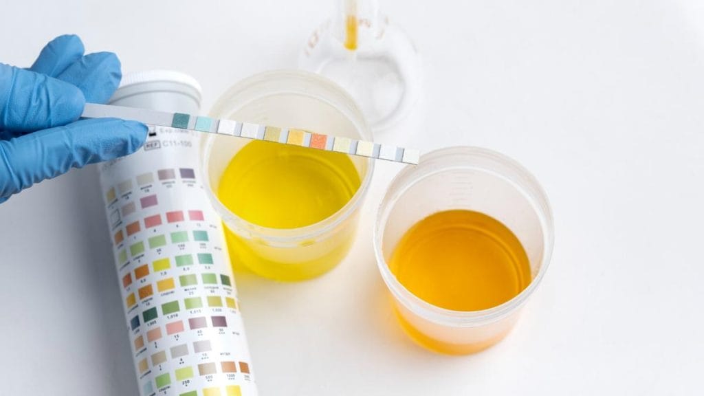 couleur urine diabetique​