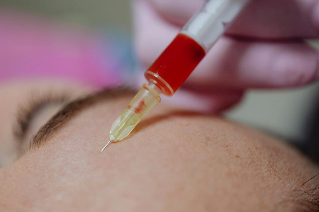 luxopuncture avant/après
