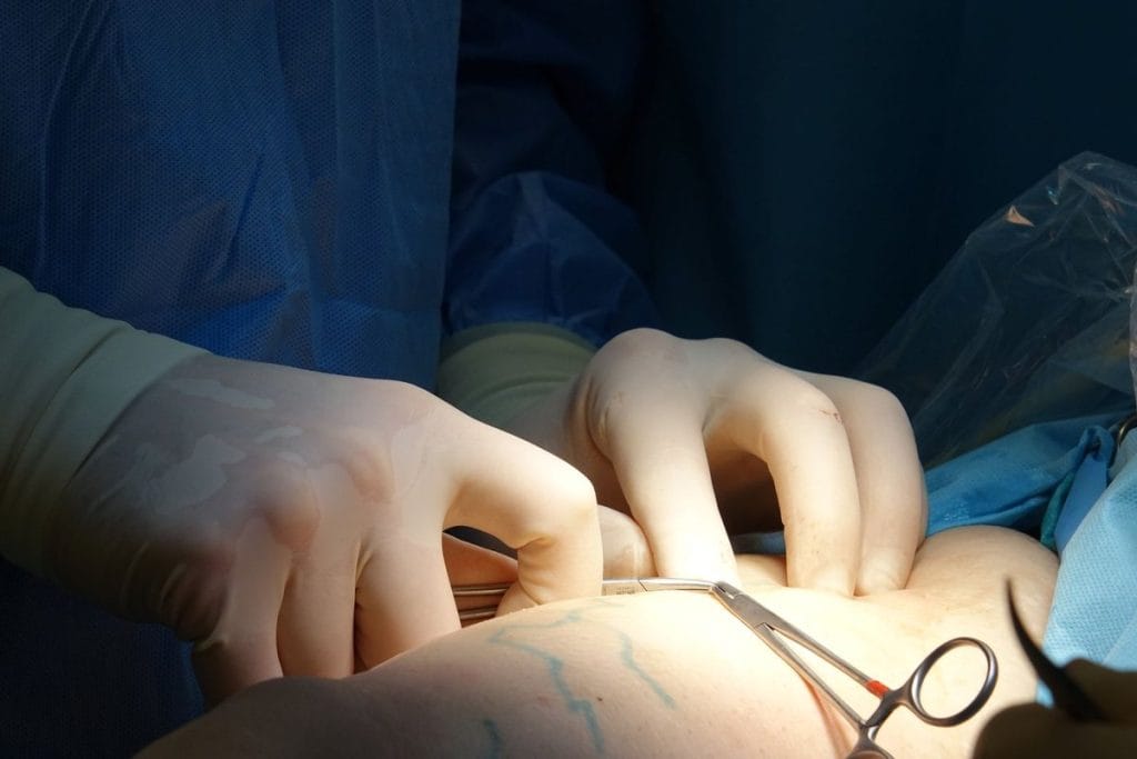 combien de temps dure une operation des varices