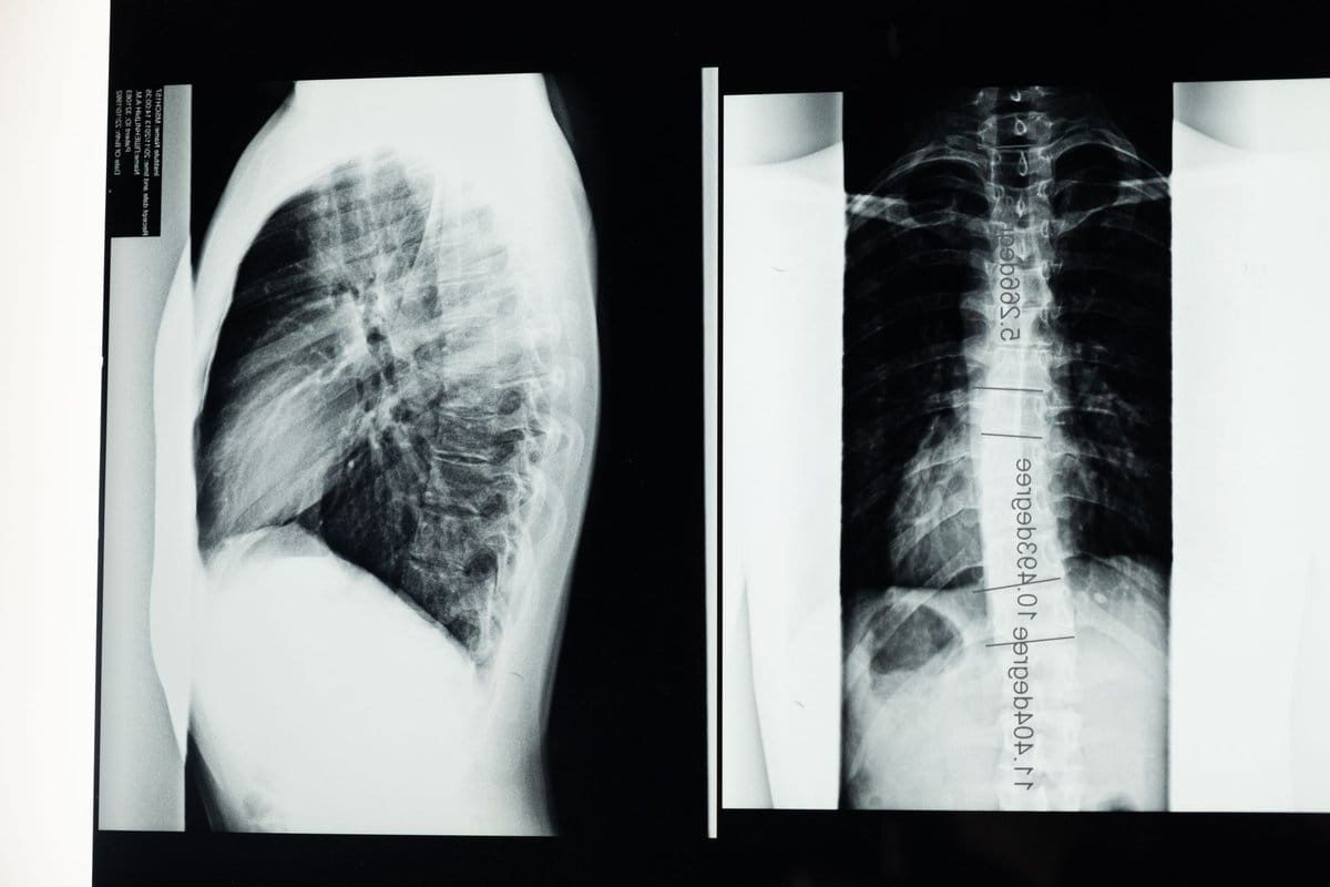 arthrodèse lombaire l5s1